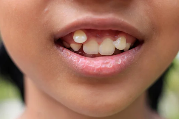 Zbliżenie Jamy Ustnej Dziecka Zagubionym Zębem Zębem Mądrości — Zdjęcie stockowe
