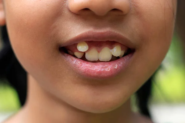 Close Boca Uma Criança Com Dente Deslocado Dente Sabedoria Imagens Royalty-Free