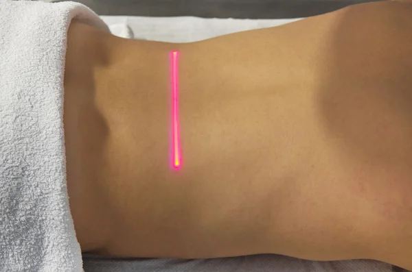 Laser treatment — Stock Photo, Image