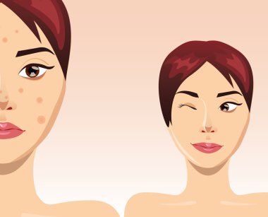 Acne treatment with beautiful woman face, vector illustration clipart