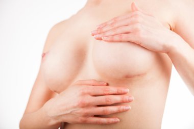 Çıplak vücut, plastik düzeltme üzerinde estetik Meme Cerrahisi sonrası yara izi