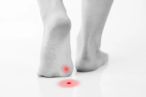 Callus or plantar wart under foot — Stock Photo, Image