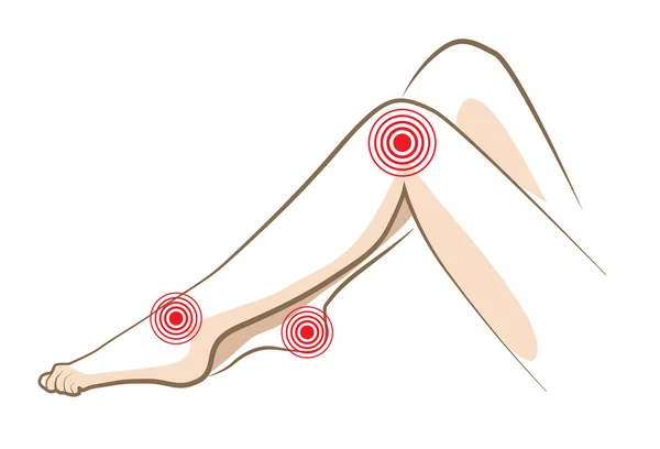 Concept of woman pain in legs, vector — Stock Vector