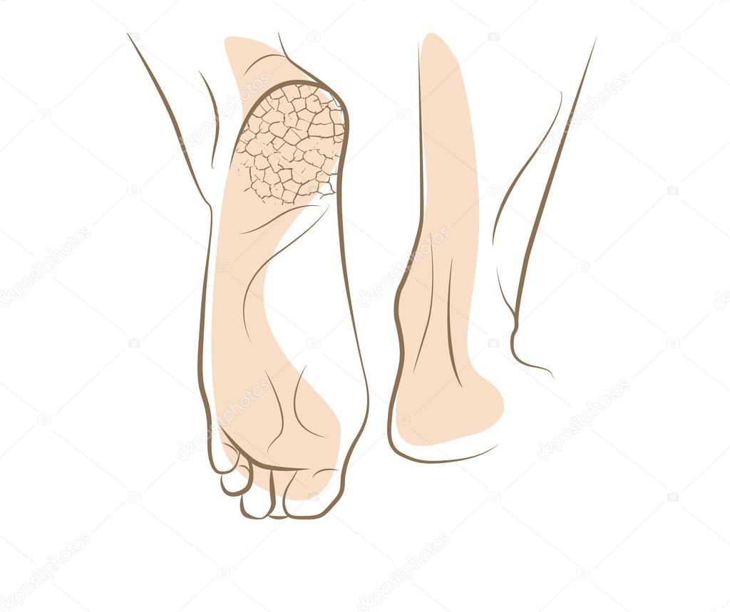 Concept of foot fungus with cracked heel, vector