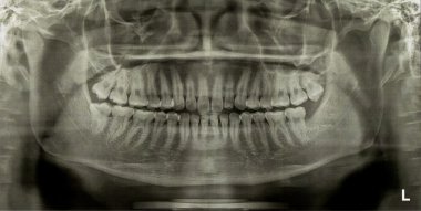 Diş grafisi X-Ray