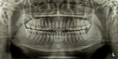 Dental Radiograph X-Ray clipart