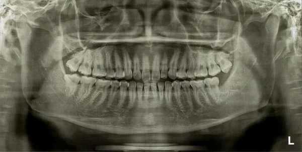 Radiografia dentale Raggi X — Foto Stock