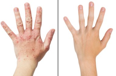 Real photo girl's hand, the patient with eczema before and after treatment clipart