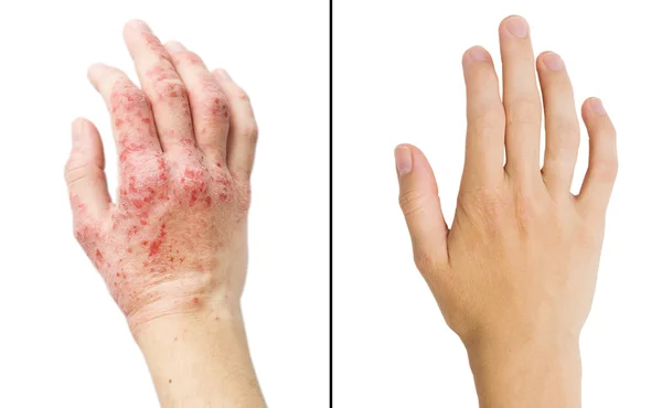 La mano di una vera ragazza fotografica, il paziente con eczema prima e dopo il trattamento — Foto Stock