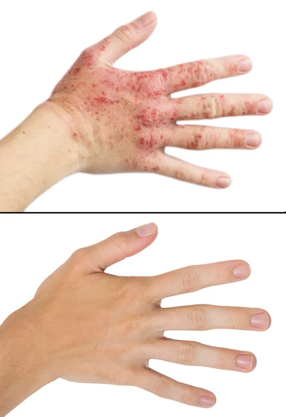 A mão da menina da foto real, o paciente com eczema antes e depois do tratamento — Fotografia de Stock