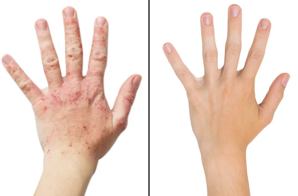 Mano de foto chica real, el paciente con eczema antes y después del tratamiento — Foto de Stock