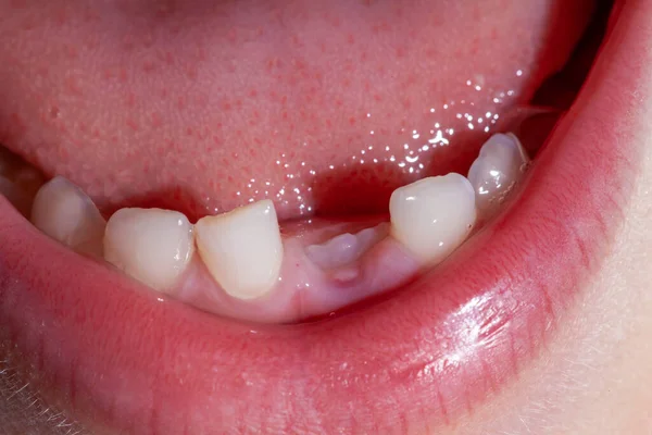 Child First Baby Tooth Fell Out Photo Macro Scale — Stock Photo, Image