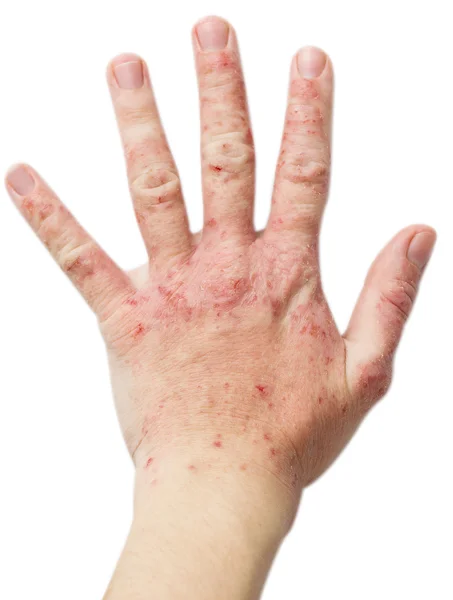 Eczema em uma mão feminina — Fotografia de Stock