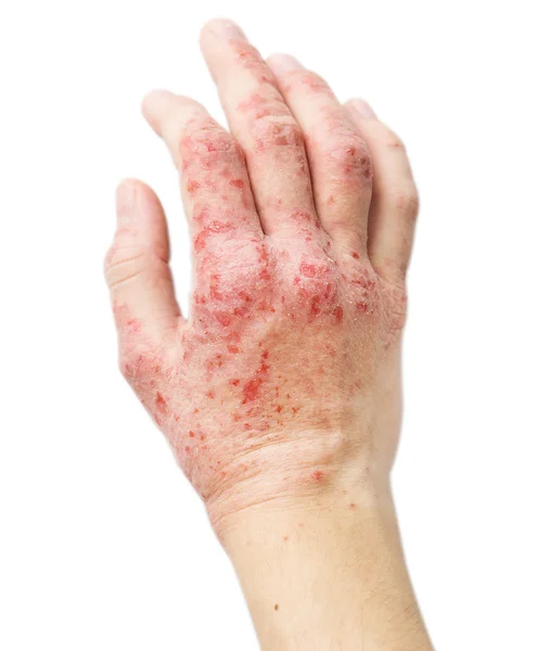 Eczema em uma mão feminina — Fotografia de Stock