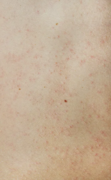 Urticaria op de buik van de persoon — Stockfoto