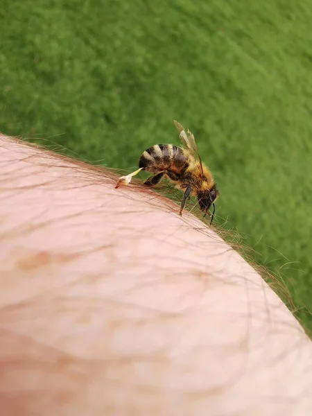 treatment with bee stings. apitherapy