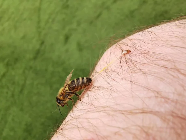 Treatment Bee Stings Apitherapy — Stock Photo, Image