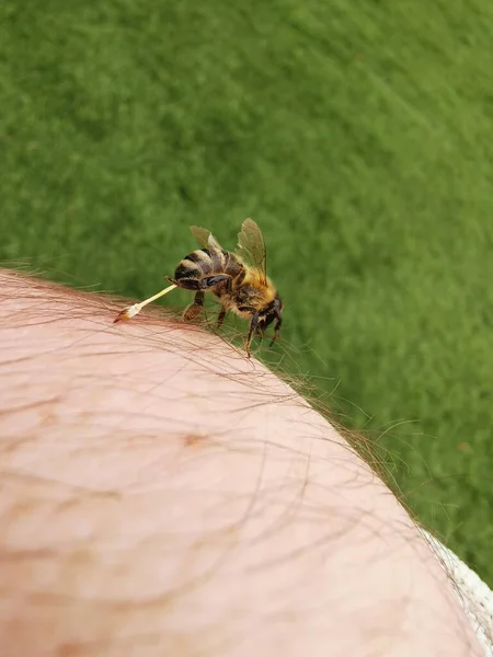 Méhcsípéssel Történő Kezelés Apiterápia — Stock Fotó