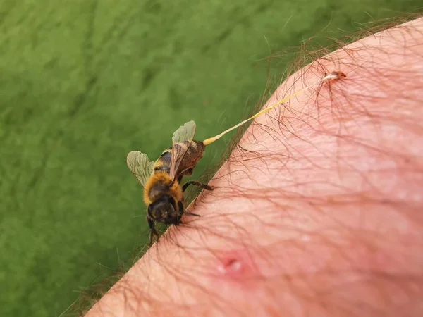 Ošetření Včelím Bodnutím Apitherapy — Stock fotografie