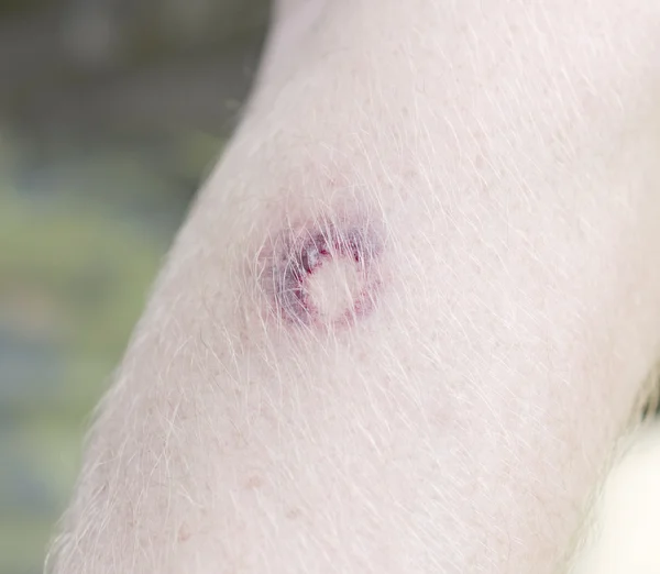 Bruise nadat paintball spelen — Stockfoto