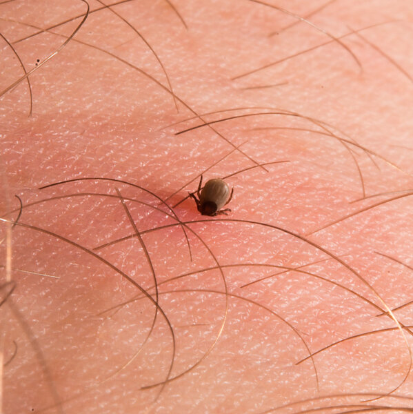 Tick sticking in human skin