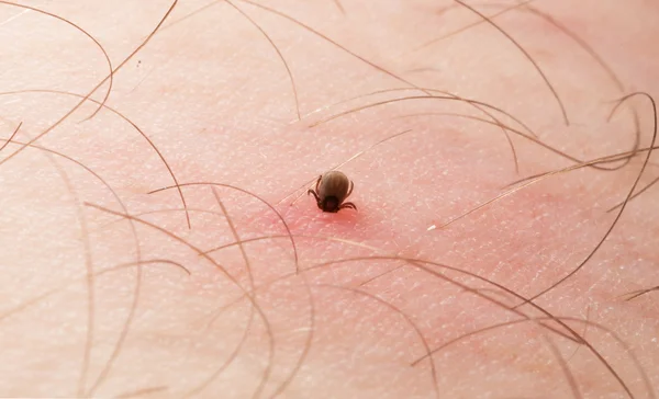 Tick lipirea în pielea umană — Fotografie, imagine de stoc