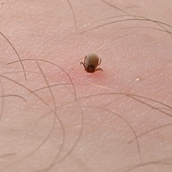 Tick with its head sticking in human skin — Stock Photo, Image