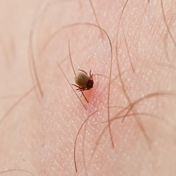 Tick with its head sticking in human skin — Stock Photo, Image