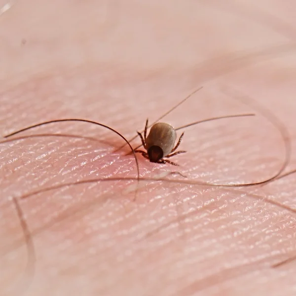 Tick with its head sticking in human skin — Stock Photo, Image