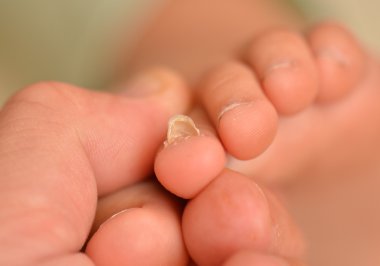 Tırnak mantar üzerinde bir ayak tirnagi