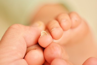 Nail fungus on a toenail clipart