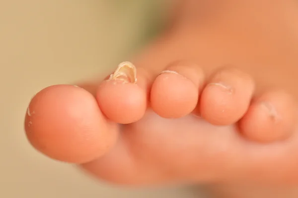 Champignon des ongles sur un ongle de pied — Photo