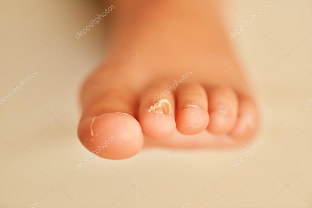 Baby with toe nail fungus -... - Kangen Water Wave | Facebook