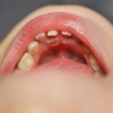 diş çıkarma sonra kız