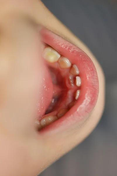 Menina após a extração dentária — Fotografia de Stock