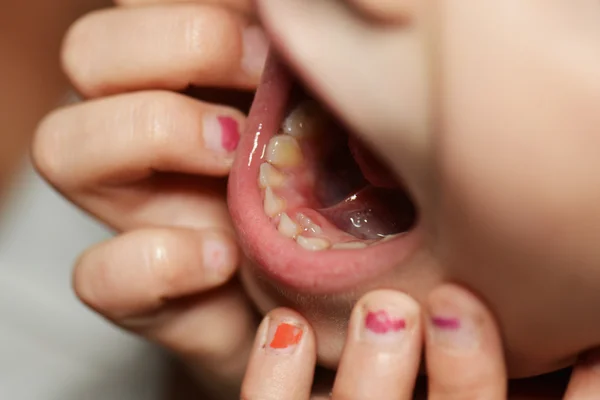 Menina após a extração dentária — Fotografia de Stock