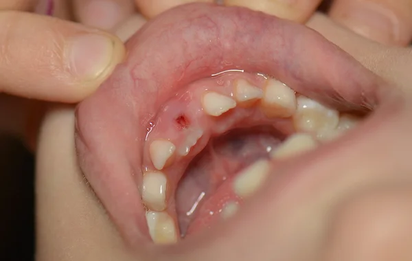 Ragazza dopo l'estrazione dentale — Foto Stock