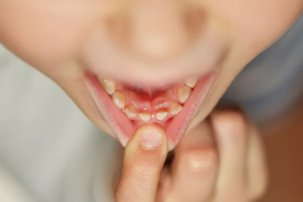 Menina após a extração dentária — Fotografia de Stock