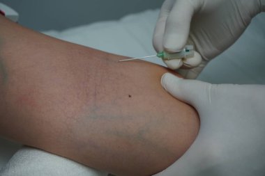 Manken kolundaki damarın delinmesi.