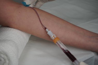 Vakum aspirasyon sistemi kullanarak sahte bir damardan kan almak.