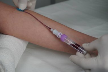 Vakum aspirasyon sistemi kullanarak sahte bir damardan kan almak.