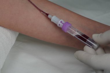 Vakum aspirasyon sistemi kullanarak sahte bir damardan kan almak.