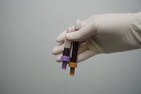 튜브를 사용하여 마네킹의 손에서 혈액을 채취하는 — 스톡 사진