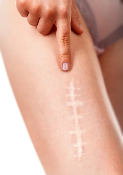 Woman showing scar — Stock Photo, Image