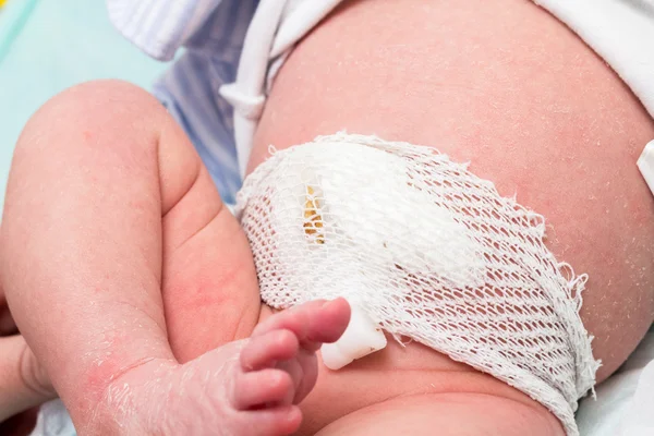 Newborn navel healthcare — Stock Photo, Image