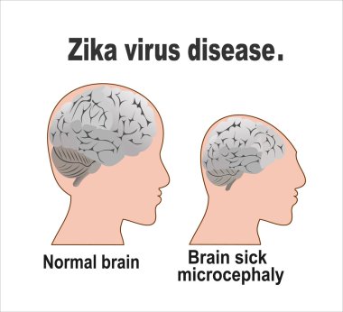 Anormal küçüklük kafa kavramı