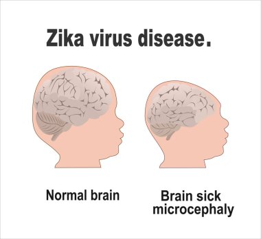 Anormal küçüklük kafa kavramı.