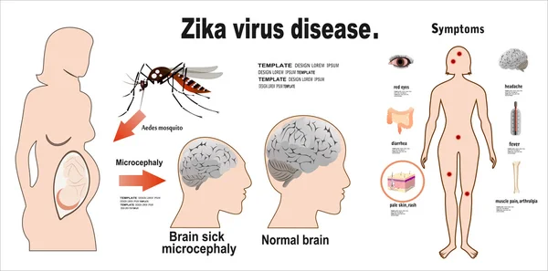 Zika 病毒症状 — 图库矢量图片
