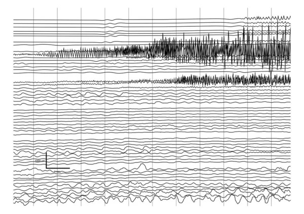 発作時の脳波記録のベクトル図 高振幅と周波数波の伝播を示す静音波 — ストックベクタ