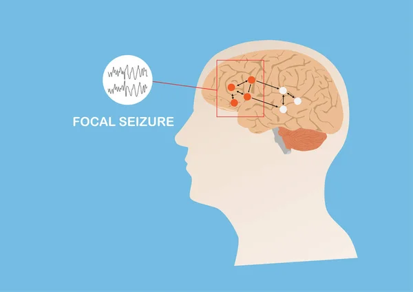 焦点発作の原因となる異常な電気活動のイラスト — ストックベクタ